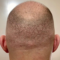 Блог об облысении и способах восстановления волос
